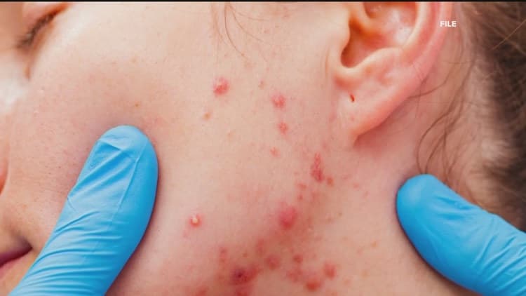 Measles Cases Surge in Georgia: What Atlanta Businesses Need to Know